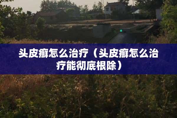 头皮癣怎么治疗（头皮癣怎么治疗能彻底根除）